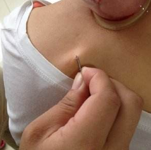 截根疗法挑羊毛疔学习班