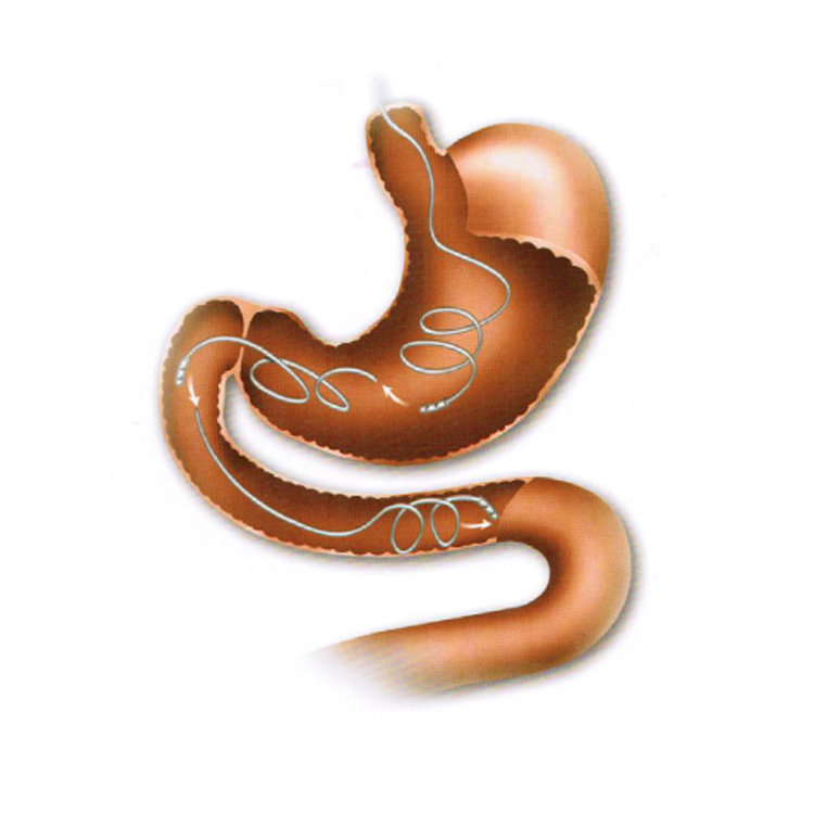 螺旋型鼻肠管 ch10-145cm