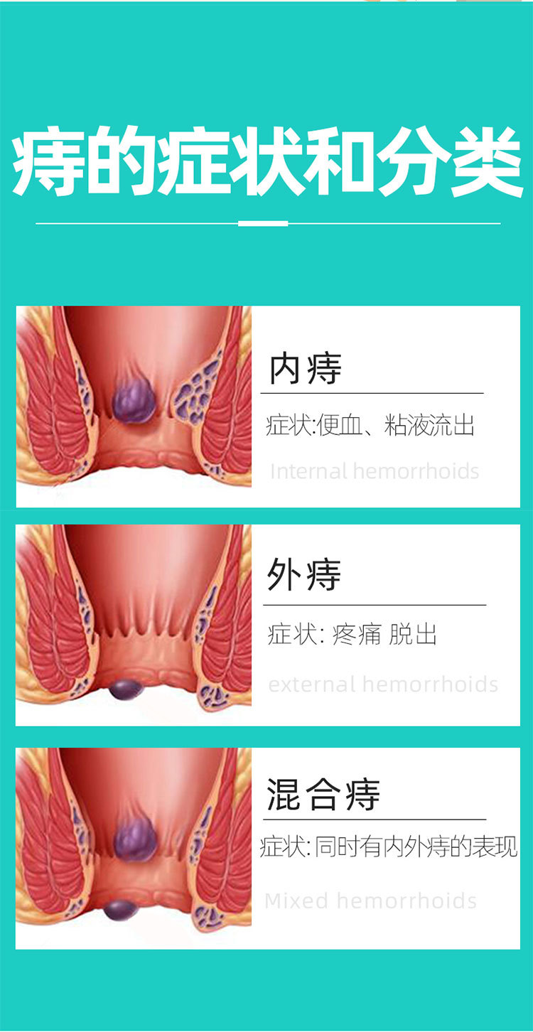 几种常见的痔疮图片图片