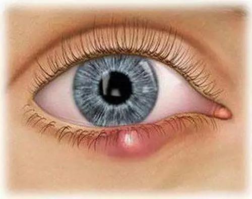 麦粒肿的一针疗法