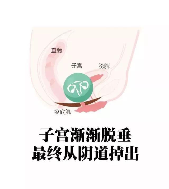 虛弱的盆底肌給了盆腔器官下垂的機會,比如子宮脫垂,yin道壁膨出.