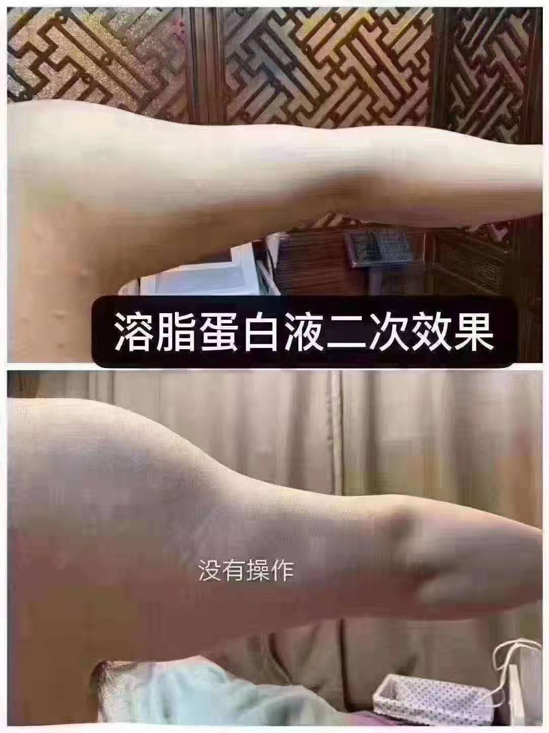 德国溶脂蛋白液安全吗