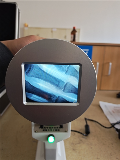 便携式骨龄检测仪 骨龄检测机 骨垢线检测生产厂家