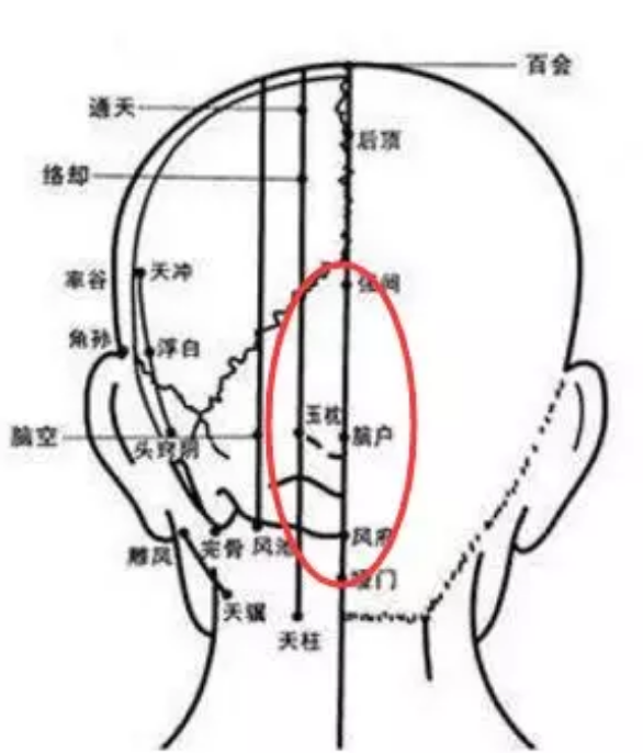 2,两侧疼又叫偏头疼(包括,太阳穴附近,及后脑勺偏两侧的位置),属