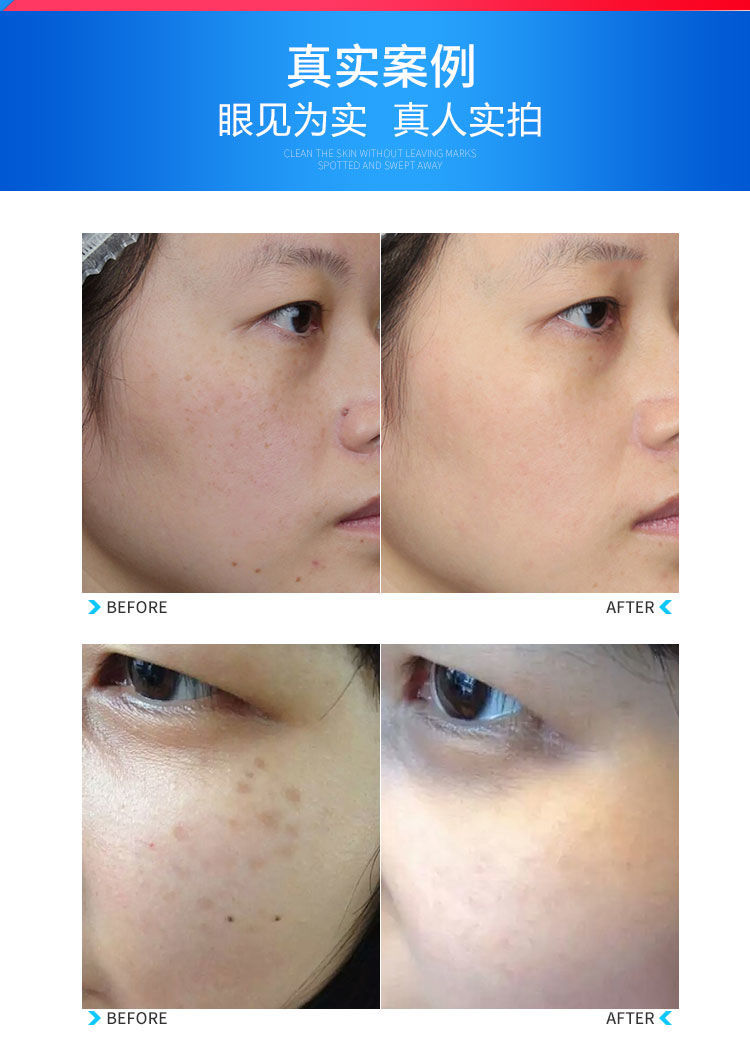 便携式拉杆箱激光洗眉机皮秒洗纹身机祛斑美白美容仪