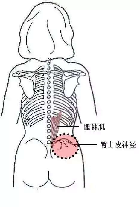 髂后上嵴内侧缘压痛点髂后上嵴内侧为骶棘肌外缘附着点,压痛常发生在