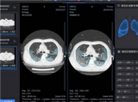 VBN-001D胸部CT影像处理软件英美达